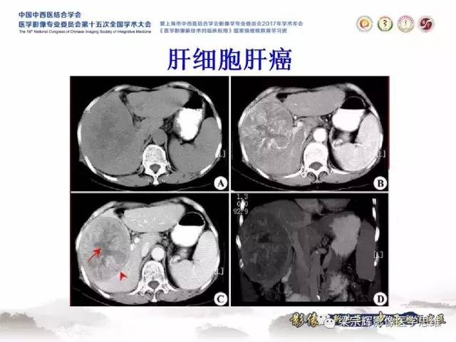 【病例】不典型肝脏海绵状血管瘤1例MR影像表现