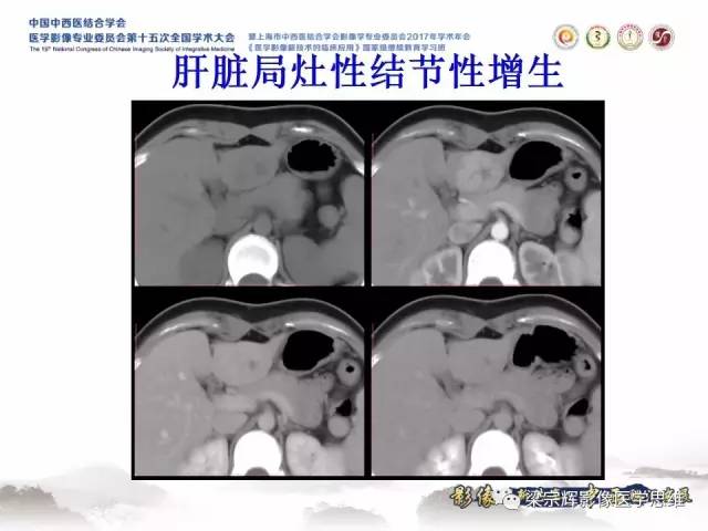 【病例】不典型肝脏海绵状血管瘤1例MR影像表现