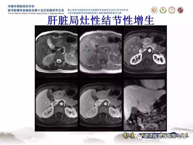 【病例】不典型肝脏海绵状血管瘤1例MR影像表现
