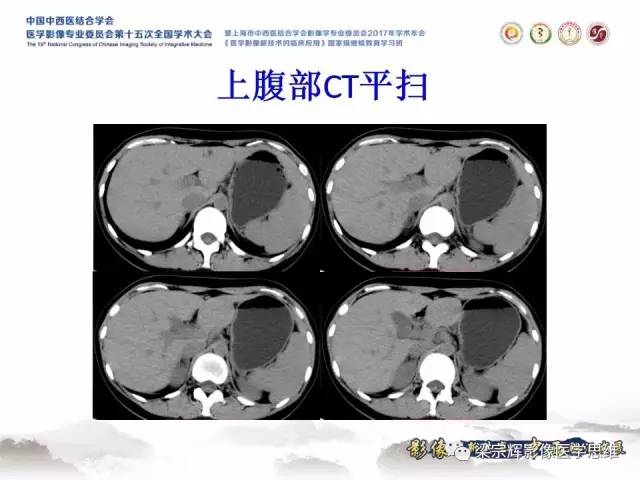 【病例】不典型肝脏海绵状血管瘤1例MR影像表现