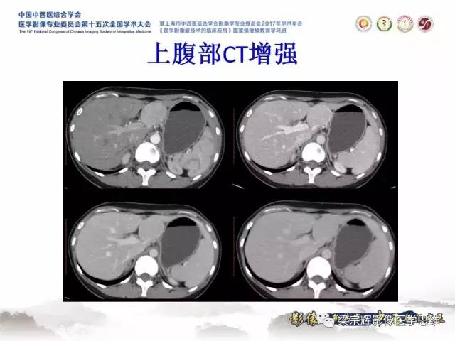 【病例】不典型肝脏海绵状血管瘤1例MR影像表现