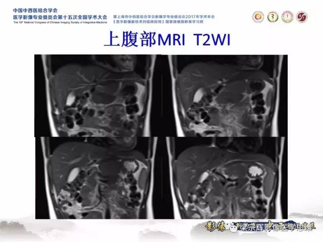 【病例】不典型肝脏海绵状血管瘤1例MR影像表现