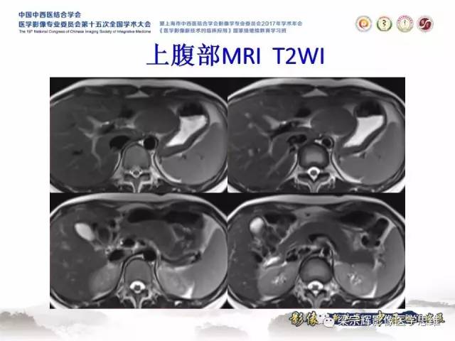 【病例】不典型肝脏海绵状血管瘤1例MR影像表现