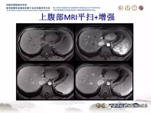【病例】不典型肝脏海绵状血管瘤1例MR影像表现