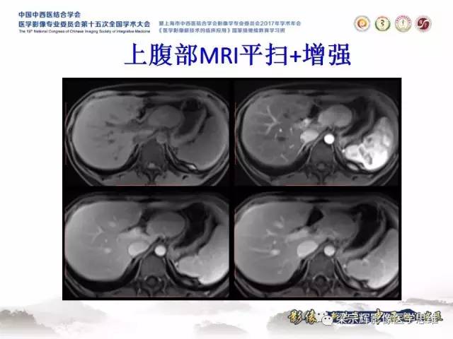 【病例】不典型肝脏海绵状血管瘤1例MR影像表现