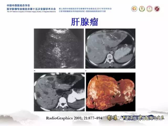 【病例】不典型肝脏海绵状血管瘤1例MR影像表现