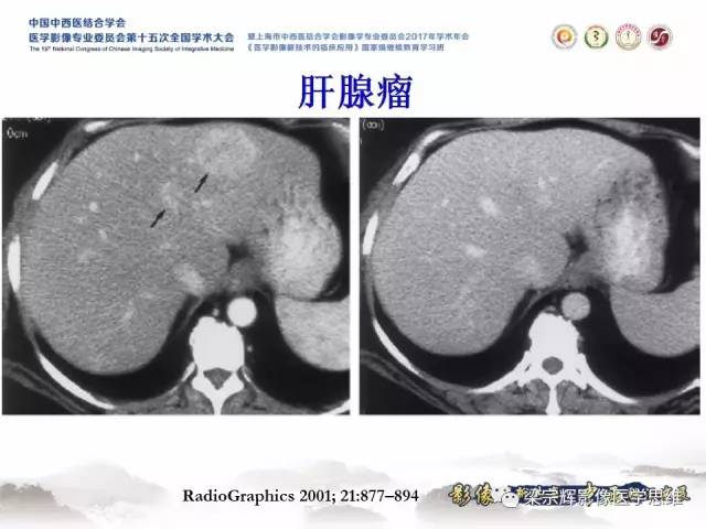 【病例】不典型肝脏海绵状血管瘤1例MR影像表现