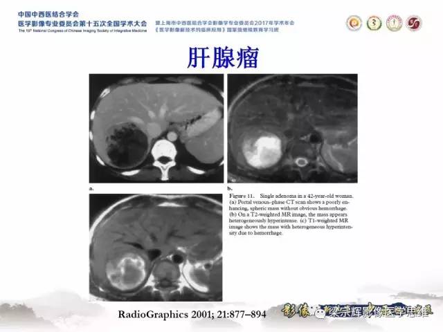 【病例】不典型肝脏海绵状血管瘤1例MR影像表现