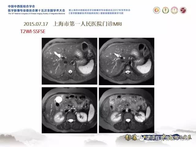 【病例】肝脏原发性淋巴瘤1例MR影像表现