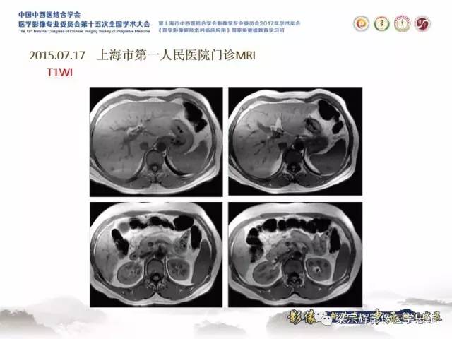 【病例】肝脏原发性淋巴瘤1例MR影像表现