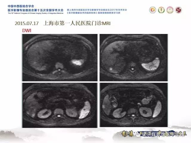 【病例】肝脏原发性淋巴瘤1例MR影像表现