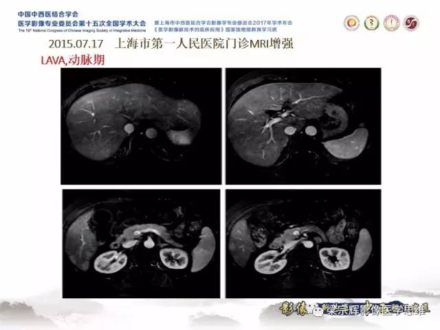【病例】肝脏原发性淋巴瘤1例MR影像表现