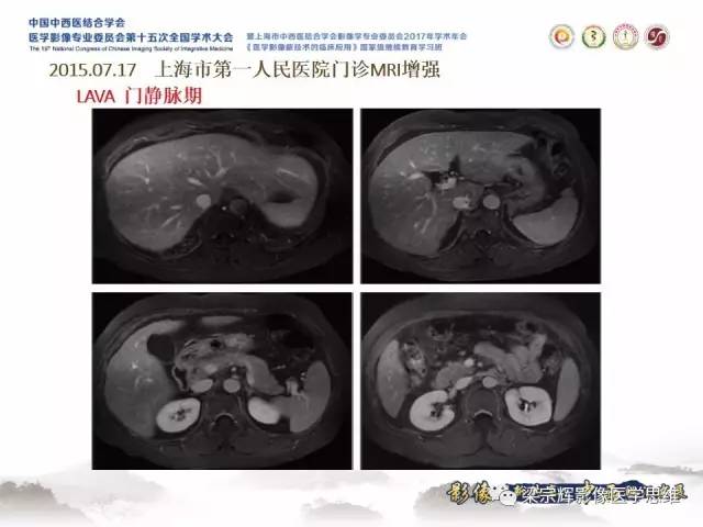 【病例】肝脏原发性淋巴瘤1例MR影像表现