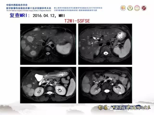 【病例】肝脏原发性淋巴瘤1例MR影像表现