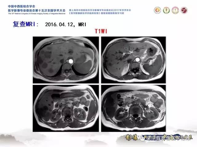 【病例】肝脏原发性淋巴瘤1例MR影像表现