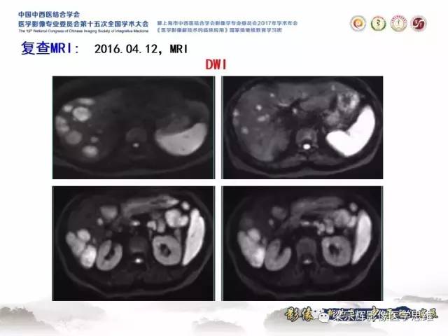 【病例】肝脏原发性淋巴瘤1例MR影像表现