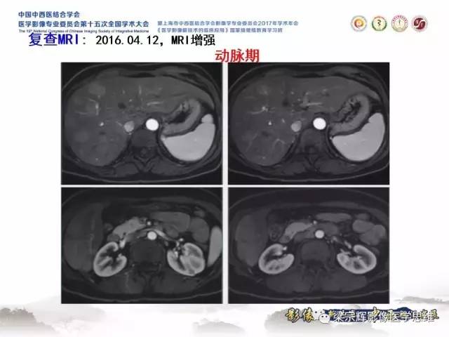 【病例】肝脏原发性淋巴瘤1例MR影像表现
