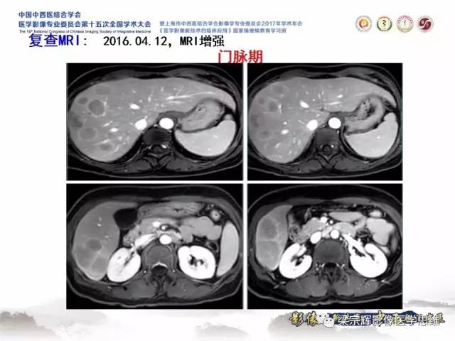 【病例】肝脏原发性淋巴瘤1例MR影像表现