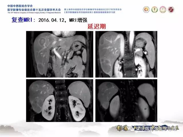 【病例】肝脏原发性淋巴瘤1例MR影像表现