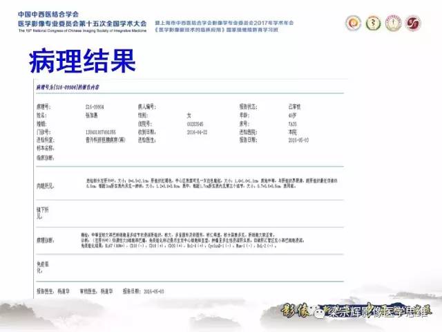 【病例】肝脏原发性淋巴瘤1例MR影像表现