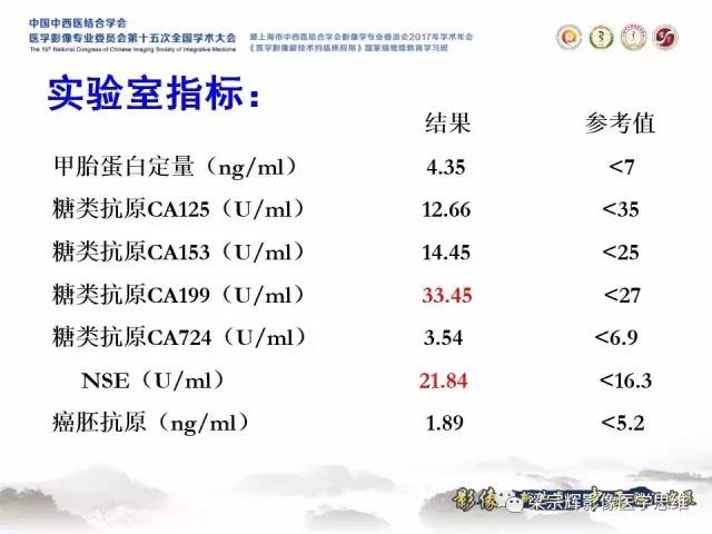 【病例】睾丸精原细胞瘤1例MR影像表现