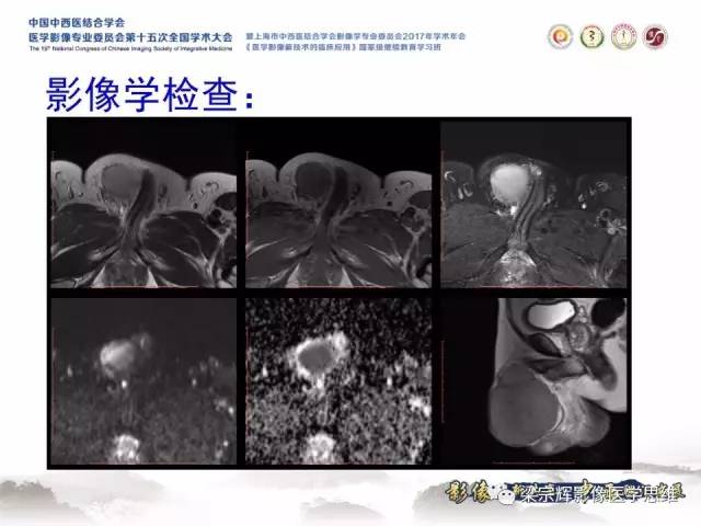 【病例】睾丸精原细胞瘤1例MR影像表现