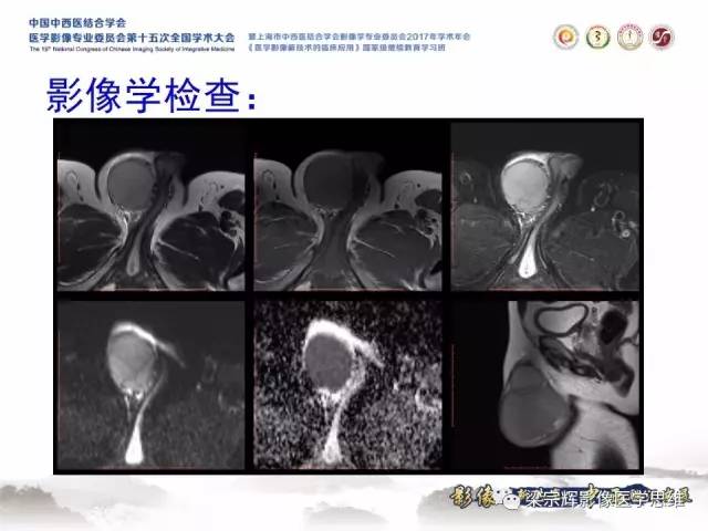 【病例】睾丸精原细胞瘤1例MR影像表现
