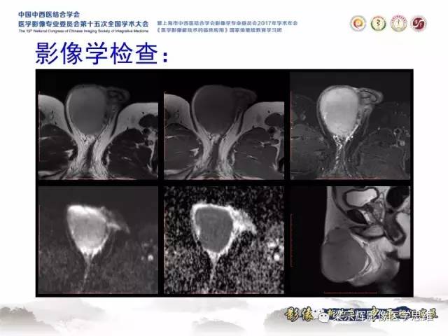 【病例】睾丸精原细胞瘤1例MR影像表现