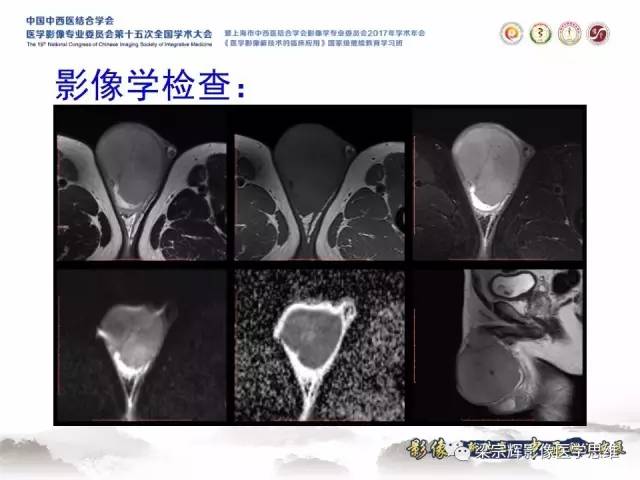 【病例】睾丸精原细胞瘤1例MR影像表现