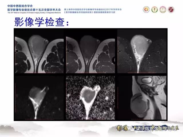 【病例】睾丸精原细胞瘤1例MR影像表现