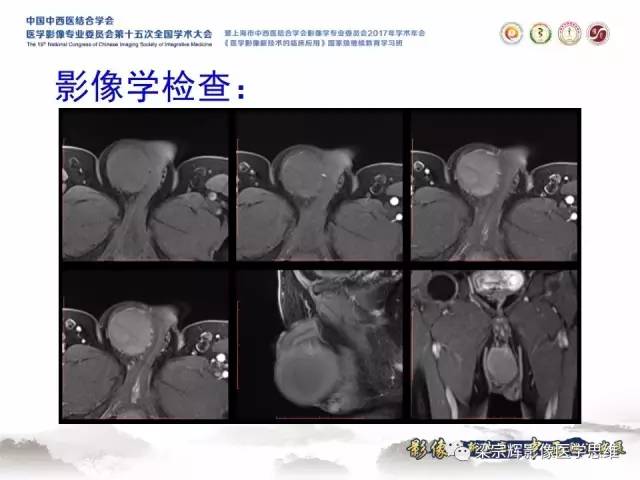 【病例】睾丸精原细胞瘤1例MR影像表现