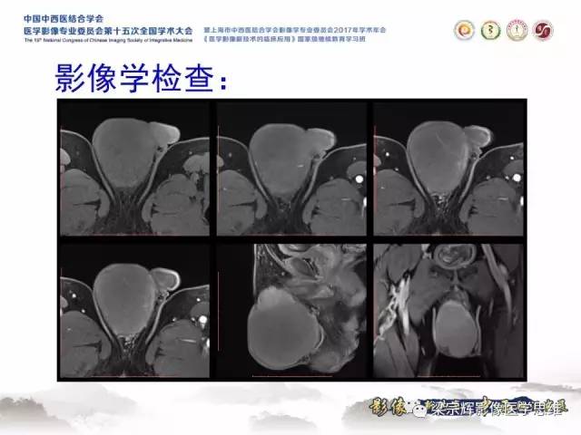 【病例】睾丸精原细胞瘤1例MR影像表现