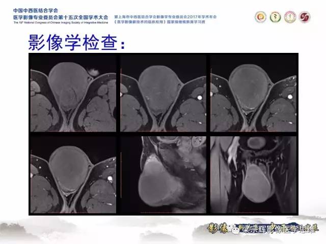【病例】睾丸精原细胞瘤1例MR影像表现