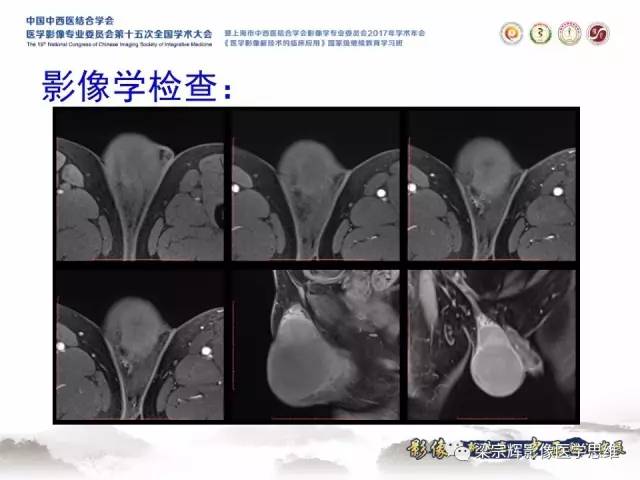 【病例】睾丸精原细胞瘤1例MR影像表现