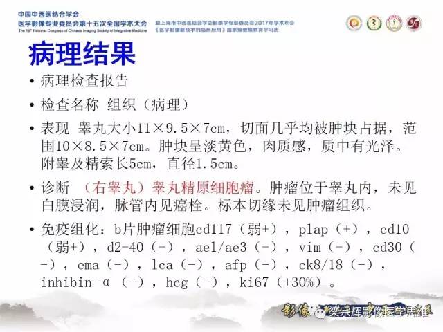 【病例】睾丸精原细胞瘤1例MR影像表现
