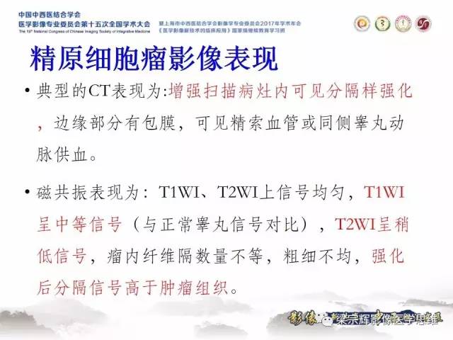 【病例】睾丸精原细胞瘤1例MR影像表现