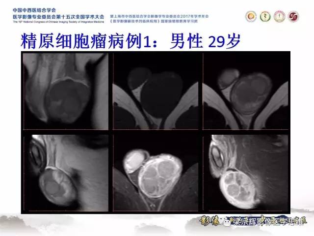 【病例】睾丸精原细胞瘤1例MR影像表现