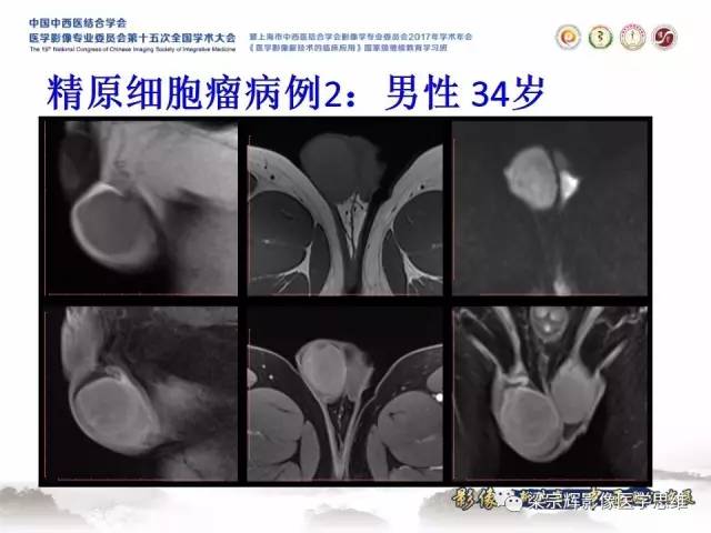 【病例】睾丸精原细胞瘤1例MR影像表现