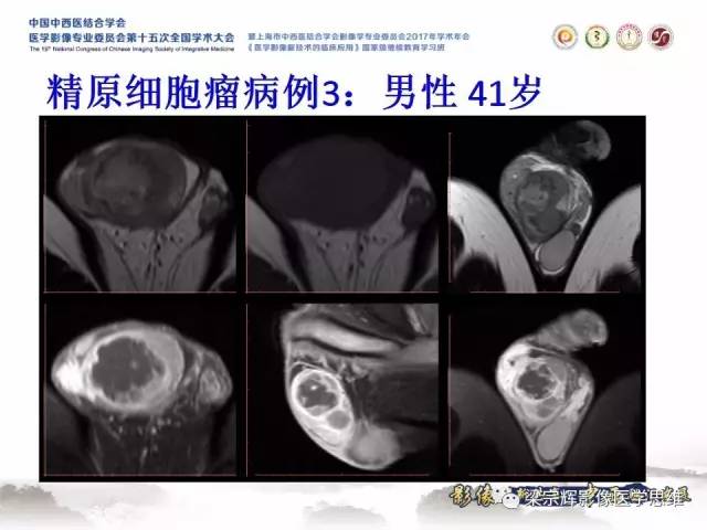 【病例】睾丸精原细胞瘤1例MR影像表现