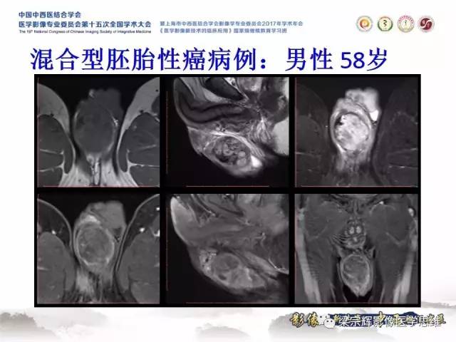 【病例】睾丸精原细胞瘤1例MR影像表现