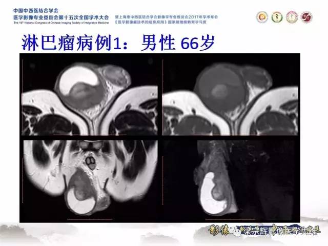 【病例】睾丸精原细胞瘤1例MR影像表现