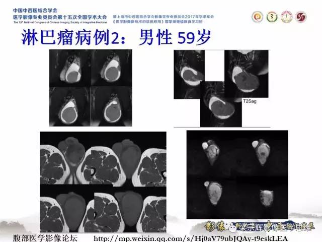 【病例】睾丸精原细胞瘤1例MR影像表现