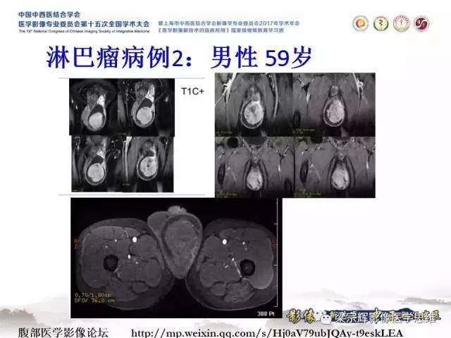 【病例】睾丸精原细胞瘤1例MR影像表现