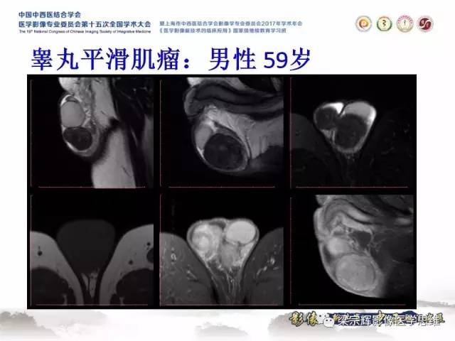 【病例】睾丸精原细胞瘤1例MR影像表现