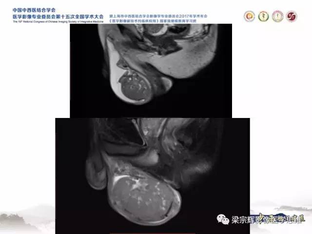 【病例】睾丸精原细胞瘤1例MR影像表现