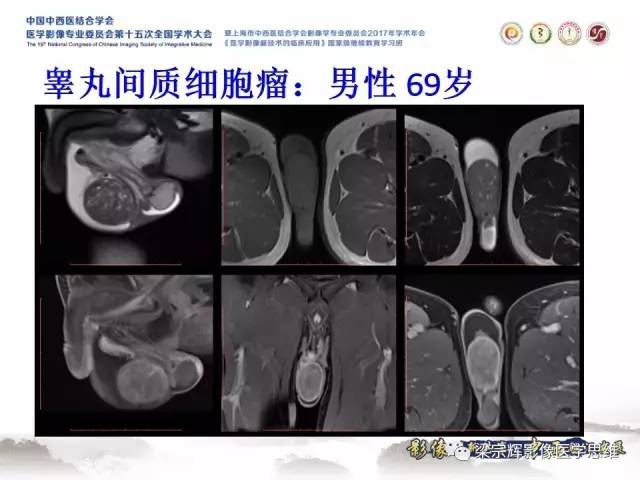 【病例】睾丸精原细胞瘤1例MR影像表现