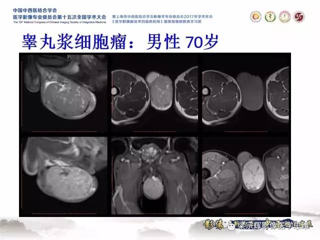 【病例】睾丸精原细胞瘤1例MR影像表现