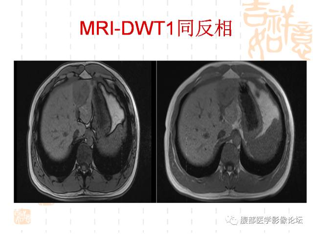 【病例】肝左外叶局灶性结节性增生FNH一例MR 【病例】肝左外叶局灶性结节性增生FNH一例MR