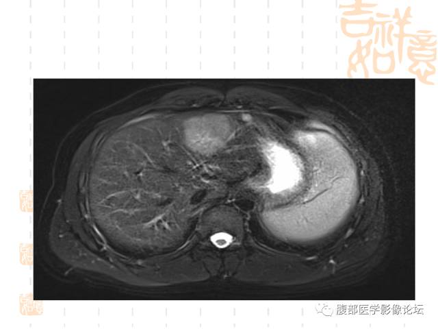 【病例】肝左外叶局灶性结节性增生FNH一例MR 【病例】肝左外叶局灶性结节性增生FNH一例MR