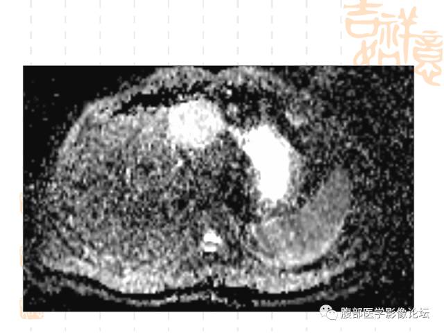 【病例】肝左外叶局灶性结节性增生FNH一例MR 【病例】肝左外叶局灶性结节性增生FNH一例MR